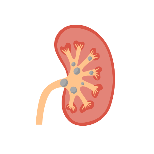 تفتيت واستخراج حصوات الكلى والحالب والمثانه بالمنظار