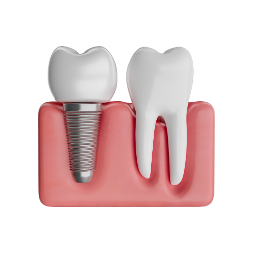 زراعة الأسنان